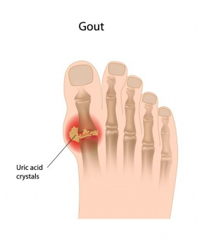 Vector ngón chân cái lớn bị bênh Gout